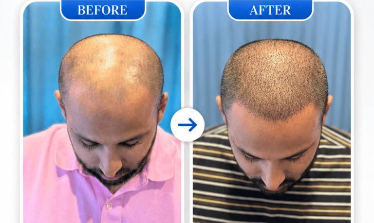 Hair Transplant at DKJ Aesthetics and Healthcare by Dr Kanwal Jawad