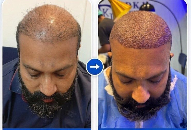 Hair Transplant at DKJ Aesthetics and Healthcare by Dr Kanwal Jawad