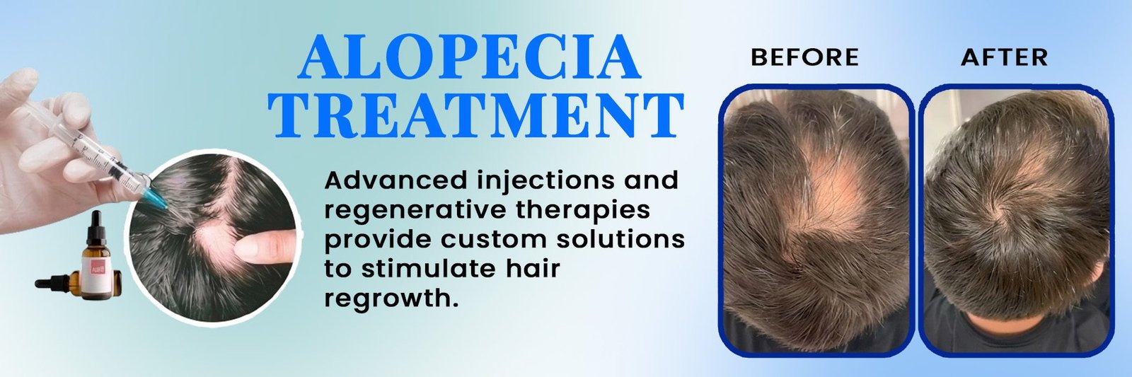 Alopecia Treatment
