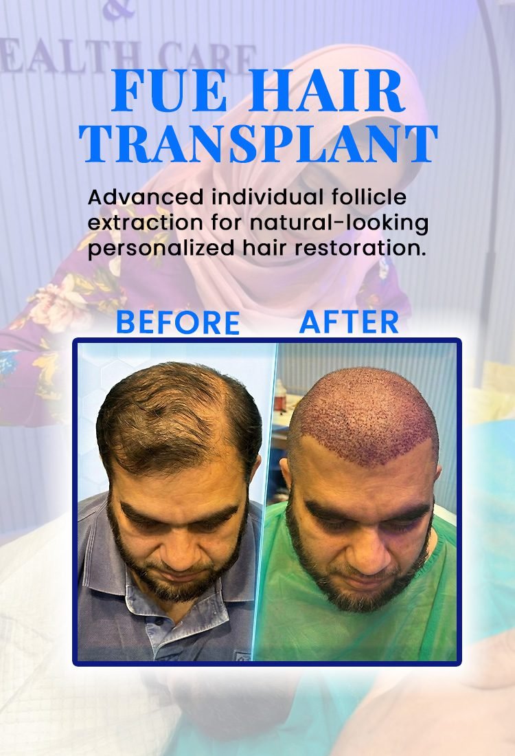 FUE hair transplant