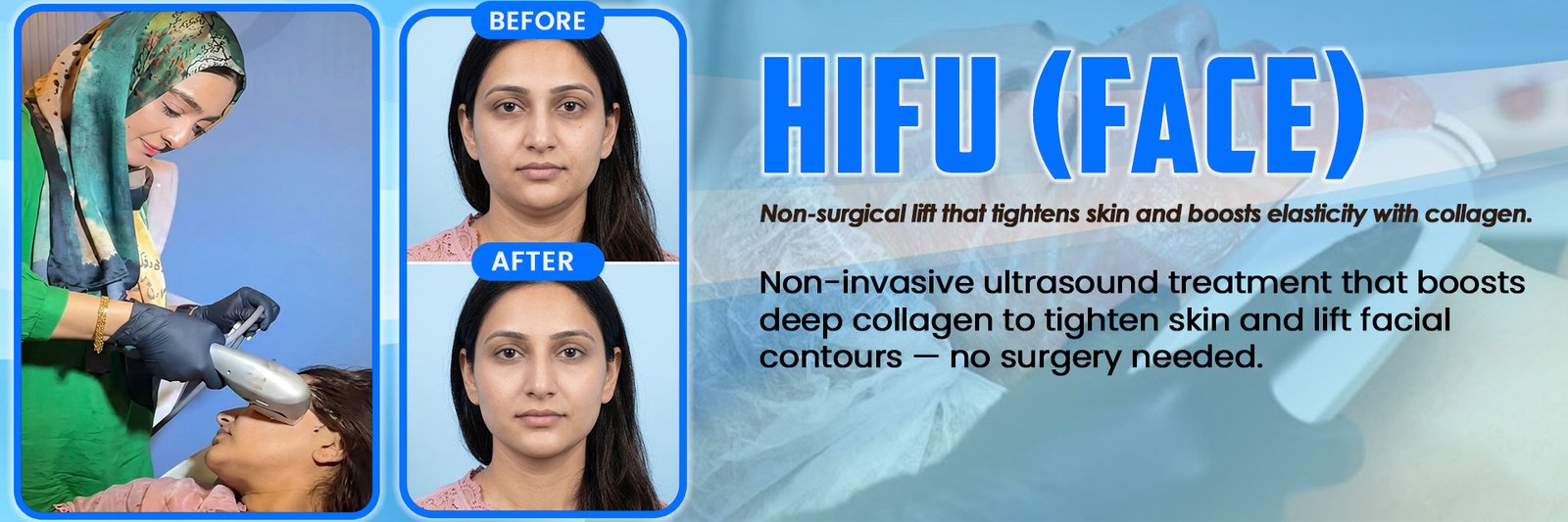HIFU (Face)