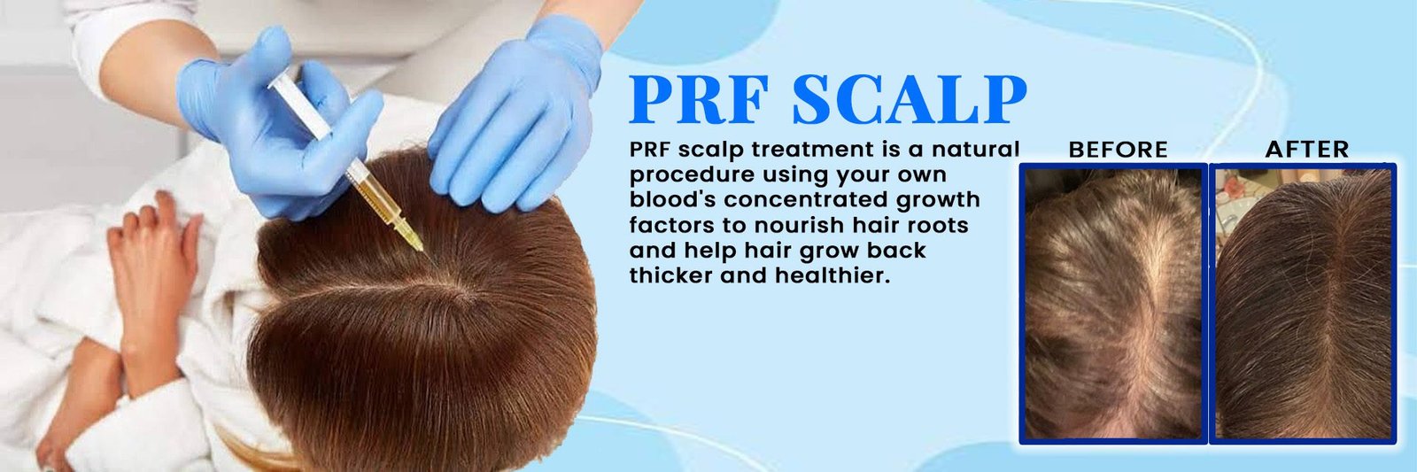 PRF SCALP