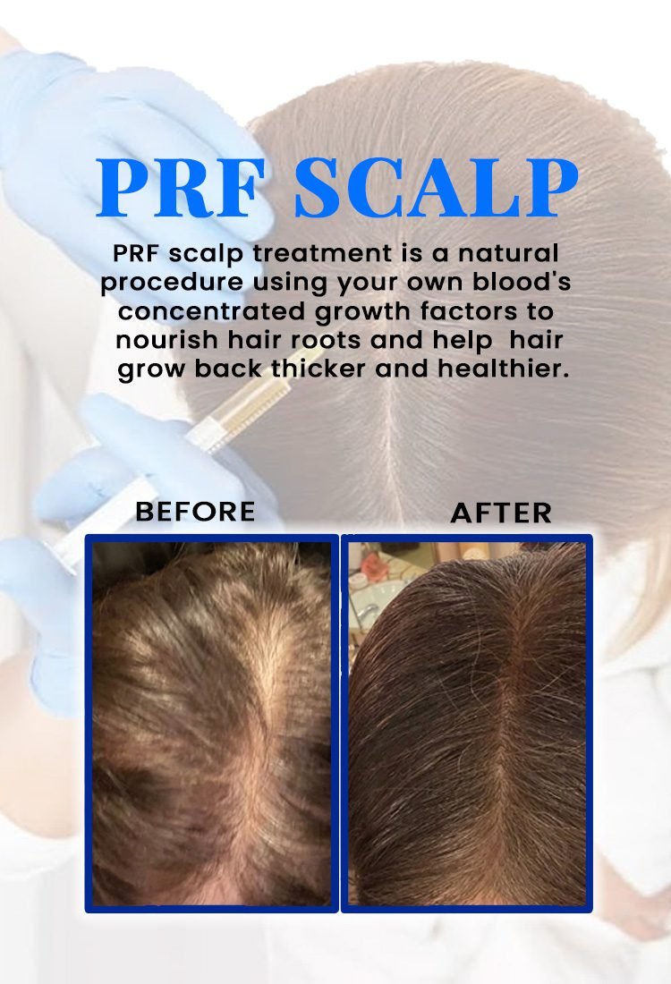 PRF SCALP