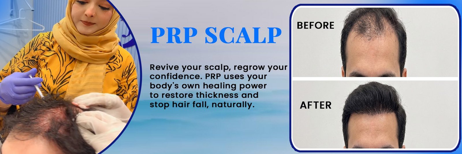 PRP Scalp