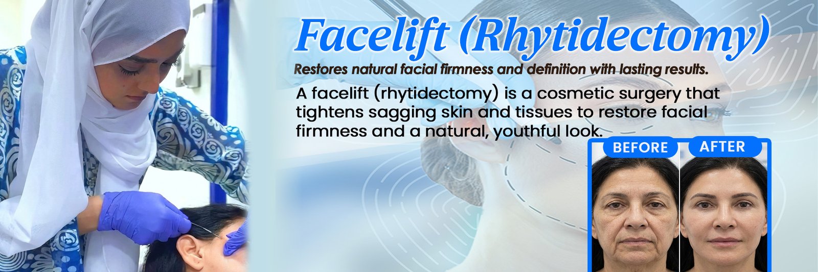 Facelift (Rhytidectomy)