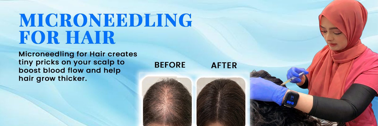 Microneedling For Hair