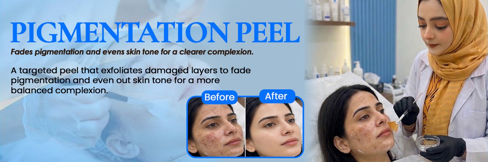 Pigmentation Peel
