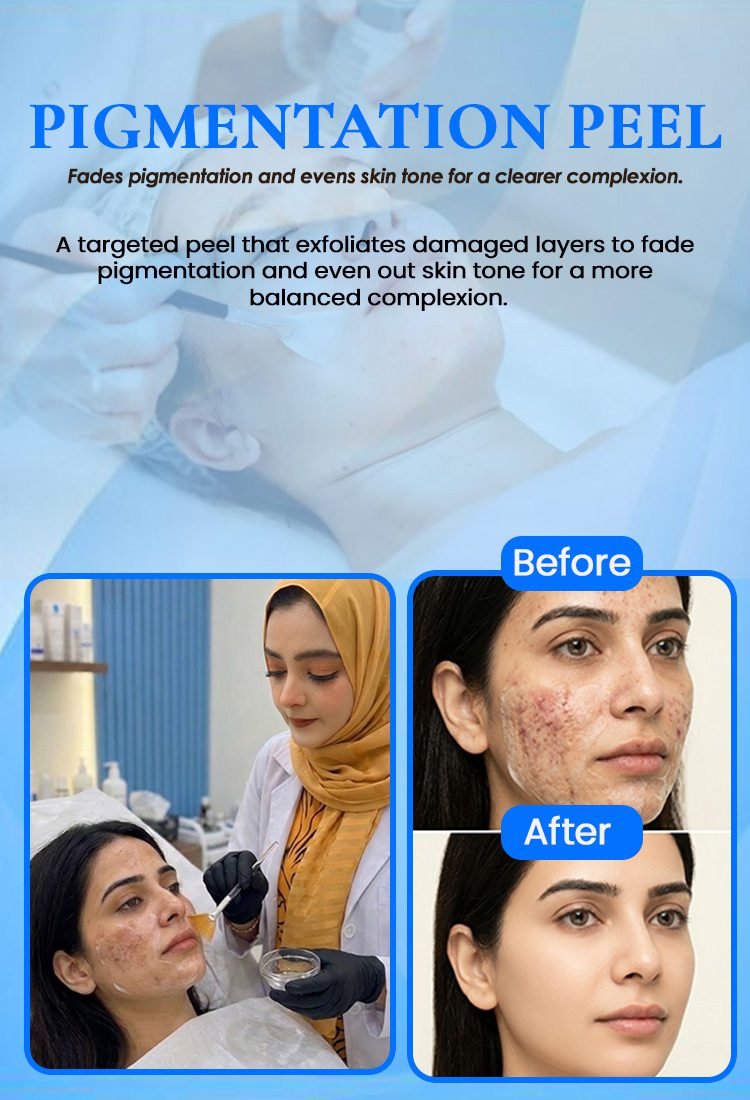 Pigmentation Peel